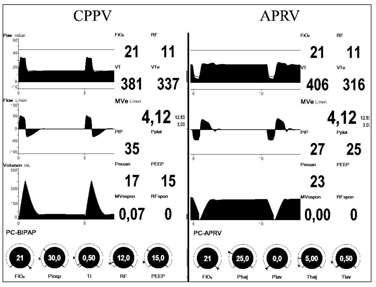 CPPV APRV